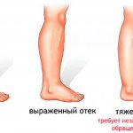 Swelling of the legs - Image 1 - Clinic Network Family Doctor