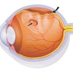Отслойка сетчатки — заболевание, характеризующееся отделением сетчатой оболочки глаза от сосудистой прослойки