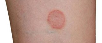 Oval spot on human skin