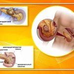 Панкреатит и рак поджелудочной железы