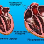 Pathological process of the heart