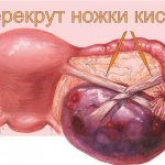 Torsion of the pedicle of the right ovarian cyst 1