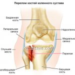 перелом костей коленного сустава
