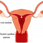cervical canal polyps