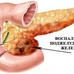 Consequences and complications of pancreatitis