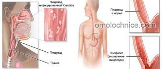 Drugs for the treatment of esophageal candidiasis