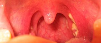 При ангине горло обычно болит с обеих сторон