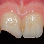 При сильном травмировании зуба нередко развивается травматический пульпит