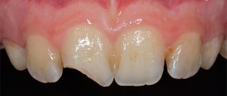 При сильном травмировании зуба нередко развивается травматический пульпит