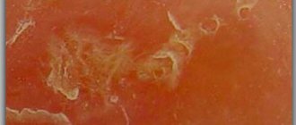 Причины болезни: ходы самки клеща в эпидермисе кожи под микроскопом