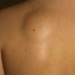 Причины и методы лечения шишек на спине под кожей