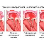 Causes of mitral insufficiency