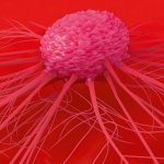Рак груди 1 стадии: лечение и профилактика