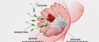 Рак молочной железы 1 стадия