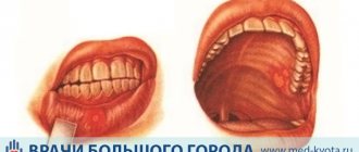 Рак слизистой оболочки полости рта