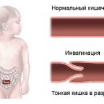 Развитие кишечной непроходимости у детей