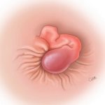 development of thrombosis photo illustration