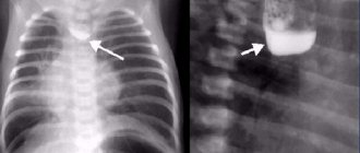 X-ray of esophageal atresia