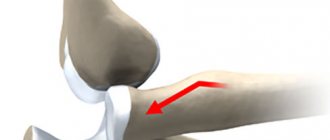 schematic complete dislocation of the elbow joint