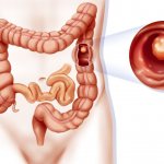 Symptoms of colon cancer in women