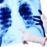 Symptoms of pneumonia in adults. How does fever, cough manifest, signs and treatment with folk remedies, antibiotics 