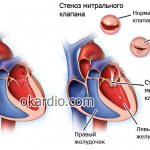 mitral valve stenosis