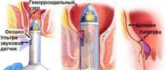 removal of hemorrhoids