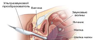Transvaginal pelvic ultrasound