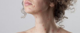 Chickenpox in adults is a rare infectious disease