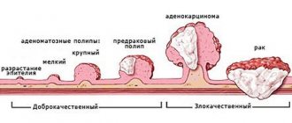 Types of adenomatous polyps