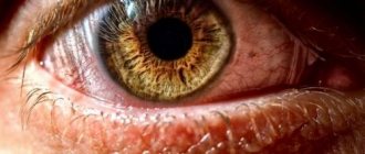 Inflammation of the eye due to dry cornea