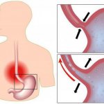 inflammation of the esophagus