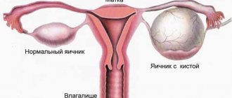 ovary with cyst