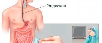 Stomach ulcer causes