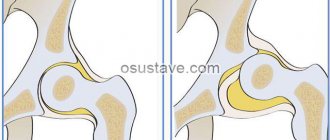 healthy hip joint and one affected by dysplasia