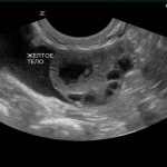 yellow body on ultrasound