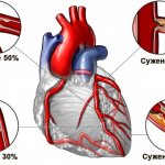 Ventricular extrasystole. What is it, treatment, what is dangerous, causes, ECG, drugs 